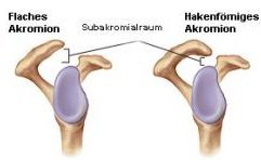 Zeichnung der Akromion-Typen