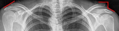 Hochstand des Schlüsselbeins