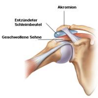 Zeichnung eines Impingementsyndroms