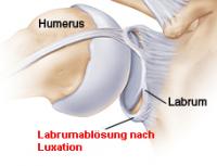 Labrumablösung nach Luxation