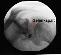 Gelenkkapsel nach der Dilatation