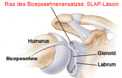 Riss des Bizepssehnenansatzes (SLAP)