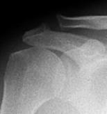 Zustand nach arthroskopischer OP