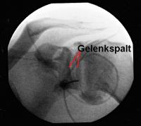 Gelenkkapsel vor der Dilatation