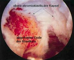 Zustand nach ACG-Resektion