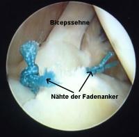 Zustand nach arthroskopischer Naht