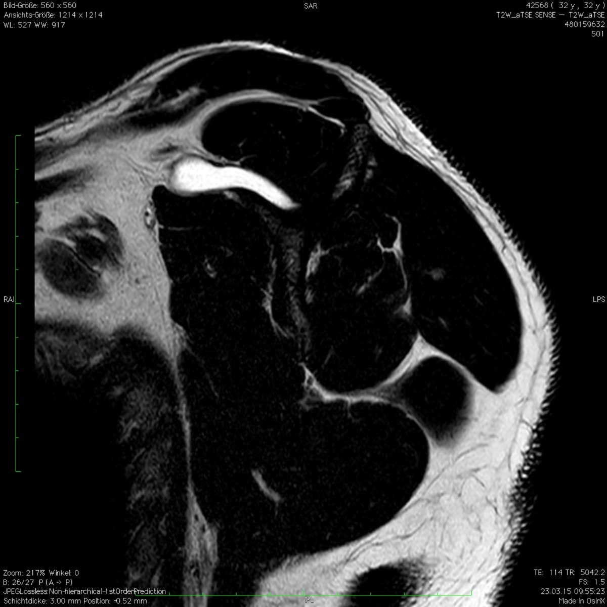 Spinoglenoidale Zyste mit Kompression am Ligamentum transversum